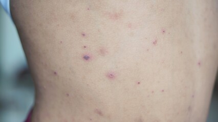 Fototapeta premium red itchy spots on the skin or chicken pox on the body