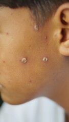Naklejka premium red itchy spots on the skin or chicken pox on the face