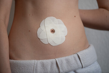 A person’s abdomen displays a circular adhesive patch designed for medical use. The patch adheres...