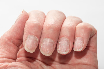 Detailed close-up of a hand showing brittle, dry, and peeling nails, with dehydrated skin on a...