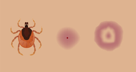 Tick biting skin causing Lyme disease and erythema migrans rash