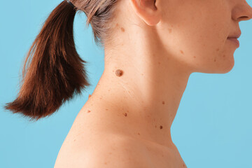 Woman with moles on her neck against blue background, closeup