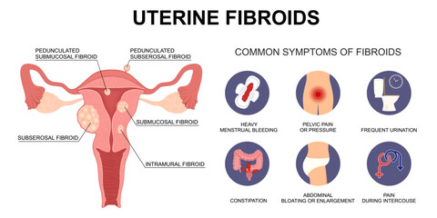Uterine Fibroids Types and Symptoms. Medical Vector Illustration