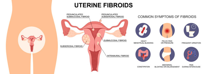 Uterine Fibroids Types and Symptoms. Medical Vector Illustration