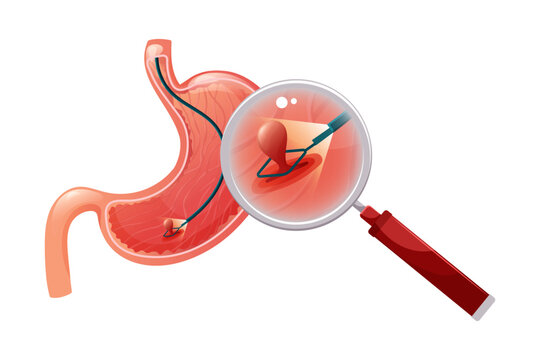Removal polyp in stomach. Enlarged view of endoscope grasping polyp with loop. Vector medical illustration.