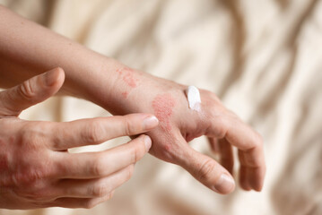 Itching on hands with redness rash. Cause of itchy skin include dermatitis (eczema), dry skin, burned, food,drug allergies, insect bites. Health care concept.