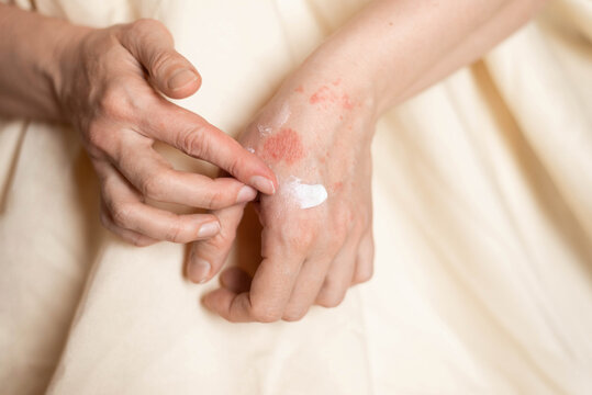 Itching on hands with redness rash. Cause of itchy skin include dermatitis (eczema), dry skin, burned, food,drug allergies, insect bites. Health care concept.