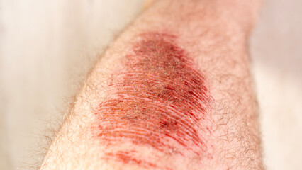 A person's arm has a bruise on it. The bruise is red and has a scab