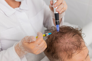 Alopecia. Man hair loss improve growth treatment regeneration dermapen microneedling vitamin exosomes plasma syringe injections. Trichologist cosmetologist doctor head procedure fractional mesotherapy