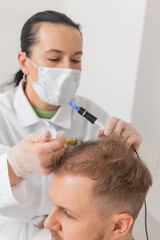 Alopecia. Man hair loss improve growth treatment regeneration, dermapen microneedling vitamin...
