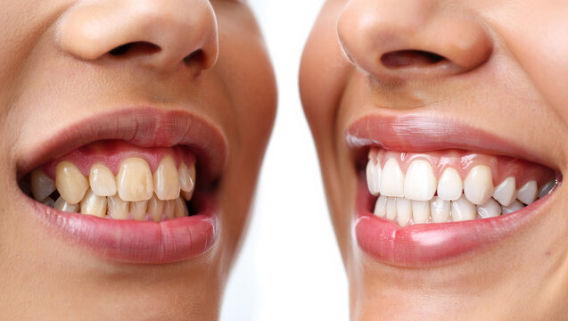 Extreme close-up comparison of woman's smile before and after teeth whitening, showing yellow stained teeth versus perfectly white teeth, dental concept