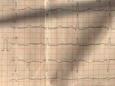 printed cardiogram