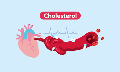 Blood vessels to the heart containing blood cells, with an artery blocked and clogged by cholesterol