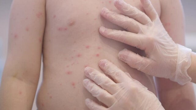 CloseUp Image of a Child Displaying Skin Rash chickenpox Symptoms for Consultation and Awareness