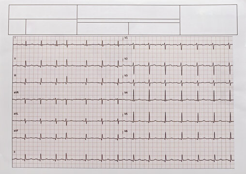 Detailed EKG, ECG, electrocardiogram showing heartbeat patterns.