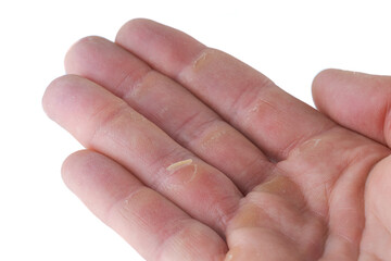 A flapper, a piece of skin, hanging from a wound on a ring finger, typical injury from climbing or...