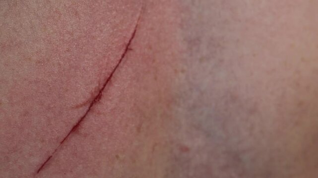 close up of fresh cat scratch on human skin with visible redness and shallow wound showing textured male skin surface and fine body hair concept of pet injury dermatology medical reference