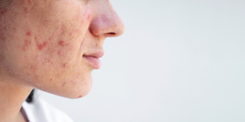 Fototapeta premium female face with acne and pimples on problem skin closeup on isolated white background