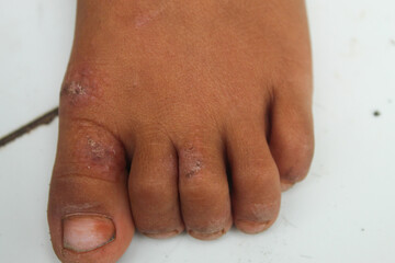 Naklejka premium psoriasis on the skin of a child's feet close up
