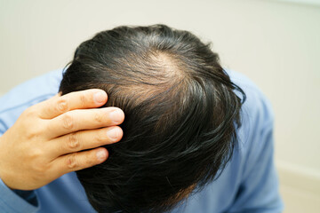 Fototapeta premium Bald head in man, hair loss treatment health problem.