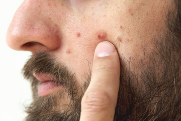 Naklejka premium Close-up of bearded man touching inflamed pimple on his cheek with finger, showing acne and skin imperfections on white background, concept skincare, dermatology, health