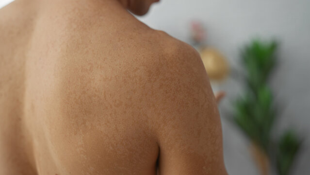 Man with shoulder pigmentation standing indoors with blurred plant in background in a peaceful home setting highlighting textured skin and natural tones.