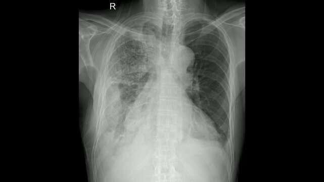 Human Chest X-Ray Showing Lung Abnormalities and Pulmonary Conditions