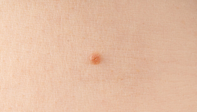 Skin mole spot closeup. Human birthmark, nevus macro texture
