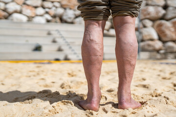 Close-up of elderly man’s bare legs with visible varicose veins, standing on sand in sunlight,...