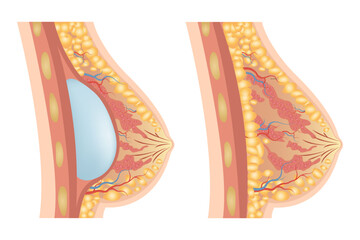 Breast augmentation with implant or breast surgery, injection of silicone gel using prepectoral and subpectoral technique,