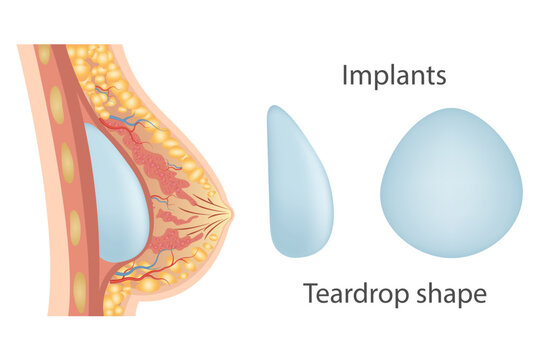 Breast augmentation with implant or breast surgery, injection of silicone gel using prepectoral and subpectoral technique,