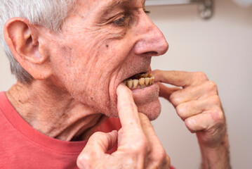 An elderly man with severely decayed teeth prepares to insert partial lower dentures, demonstrating...