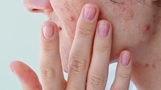 A young girl with problematic sensitive skin, suffering from acne, post-acne. Dermatological problems