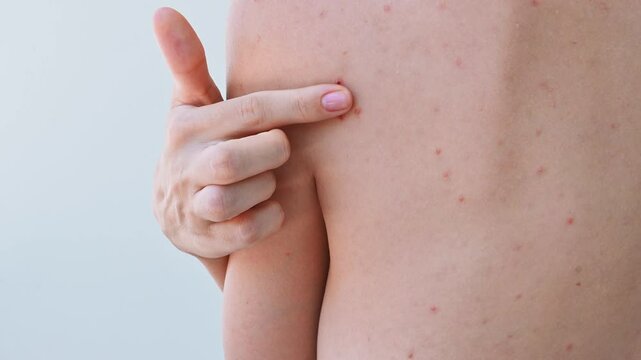 Close-up of the skin on the shoulder of a young girl with problems. Pimples, acne, pores, scars. Natural skin without filters.
