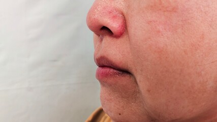 close up the flabbiness and wrinkle beside the mouth, dark spots and blemish, freckles and scar on the face of the woman, health care and beauty concept.