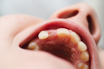 Orthodontist examining kid mouth. The tooth is growing in the wrong place