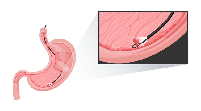 Removal polyp in stomach. Enlarged view of endoscope grasping polyp with loop. Vector medical illustration.