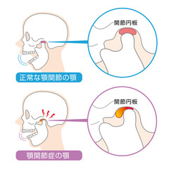 顎関節症の症状と説明のイラスト