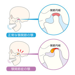 顎関節症の症状と説明のイラスト
