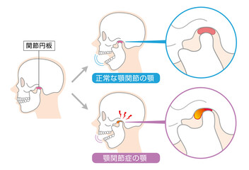 顎関節症の症状と説明のイラスト