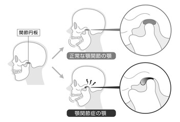 顎関節症の症状と説明のイラスト　モノトーン