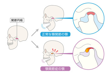 顎関節症の症状と説明のイラスト