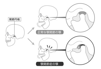 顎関節症の症状と説明のイラスト　モノトーン