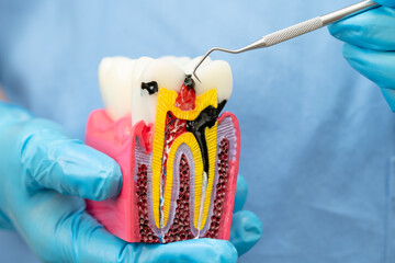 Asian dentist holding dental implant, artificial tooth roots into jaw, root canal of dental...