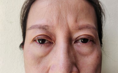 portrait the wrinkle and Flabby skin beside the eyelids, swelling and ptosis under the eyes, sadness and worry of the young woman, health care concept.