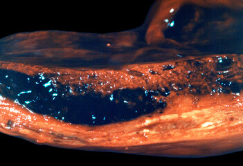 Human fetus. Miscarriage