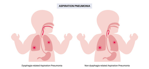Aspiration pneumonia poster