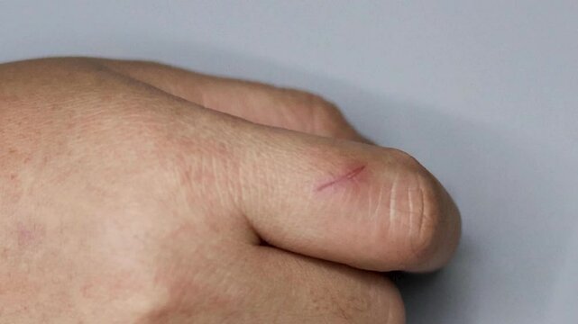 Close-Up of Healing Finger Cut Over Time
