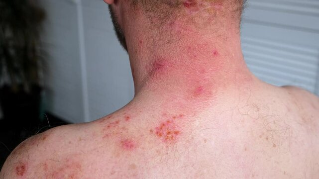 Skin lesion symptom in Shingles or Herpes zoster in person. Viral disease Varicella virus. Painful skin rash with blisters on the body. Red pimples. Insects bite. Body injury. High quality 4k footage.