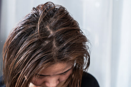 asian woman with oily scalp and thinning hair, feeling uncomfortable with greasy roots and hair loss, possibly caused by scalp problems like dandruff, eczema, or too much oil production